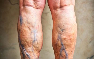 Adiós a las Varices con Moxibustión